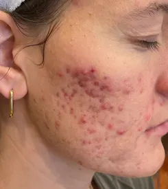 acne treatment