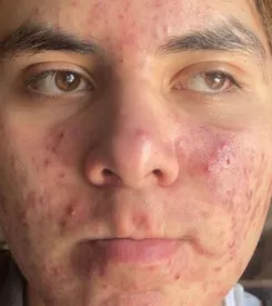 acne treatment
