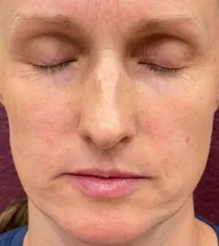 advalight results before and after