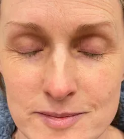advalight results before and after
