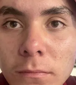 acne treatment