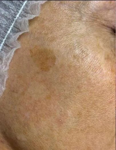 advalight results before and after