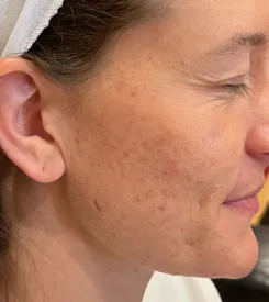 acne treatment