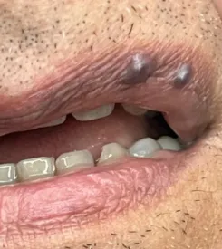 advalight results before and after