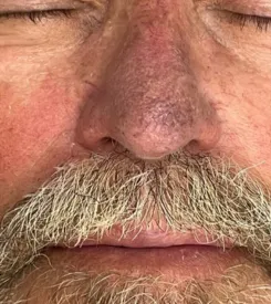 advalight results before and after