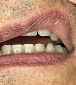 advalight results before and after