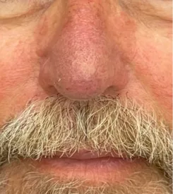 advalight results before and after