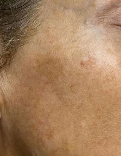 advalight results before and after