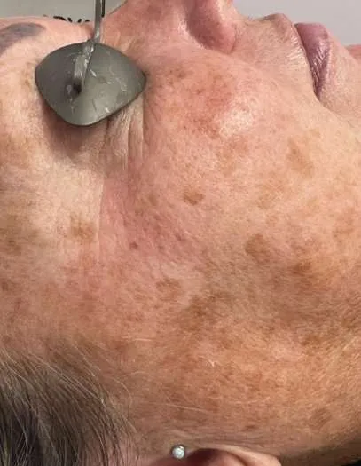 advalight results before and after