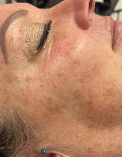 advalight results before and after