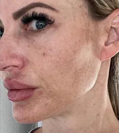 advalight results before and after