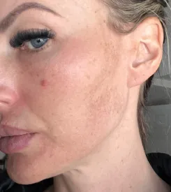 advalight results before and after