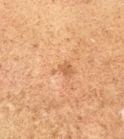 advalight results before and after
