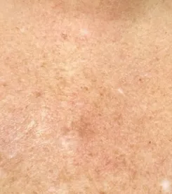 advalight results before and after