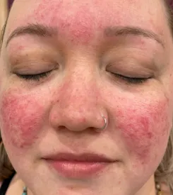 advalight results before and after