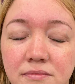 advalight results before and after