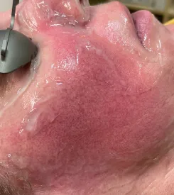 advalight results before and after