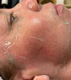 advalight results before and after
