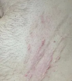 advalight results before and after