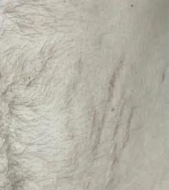 advalight results before and after