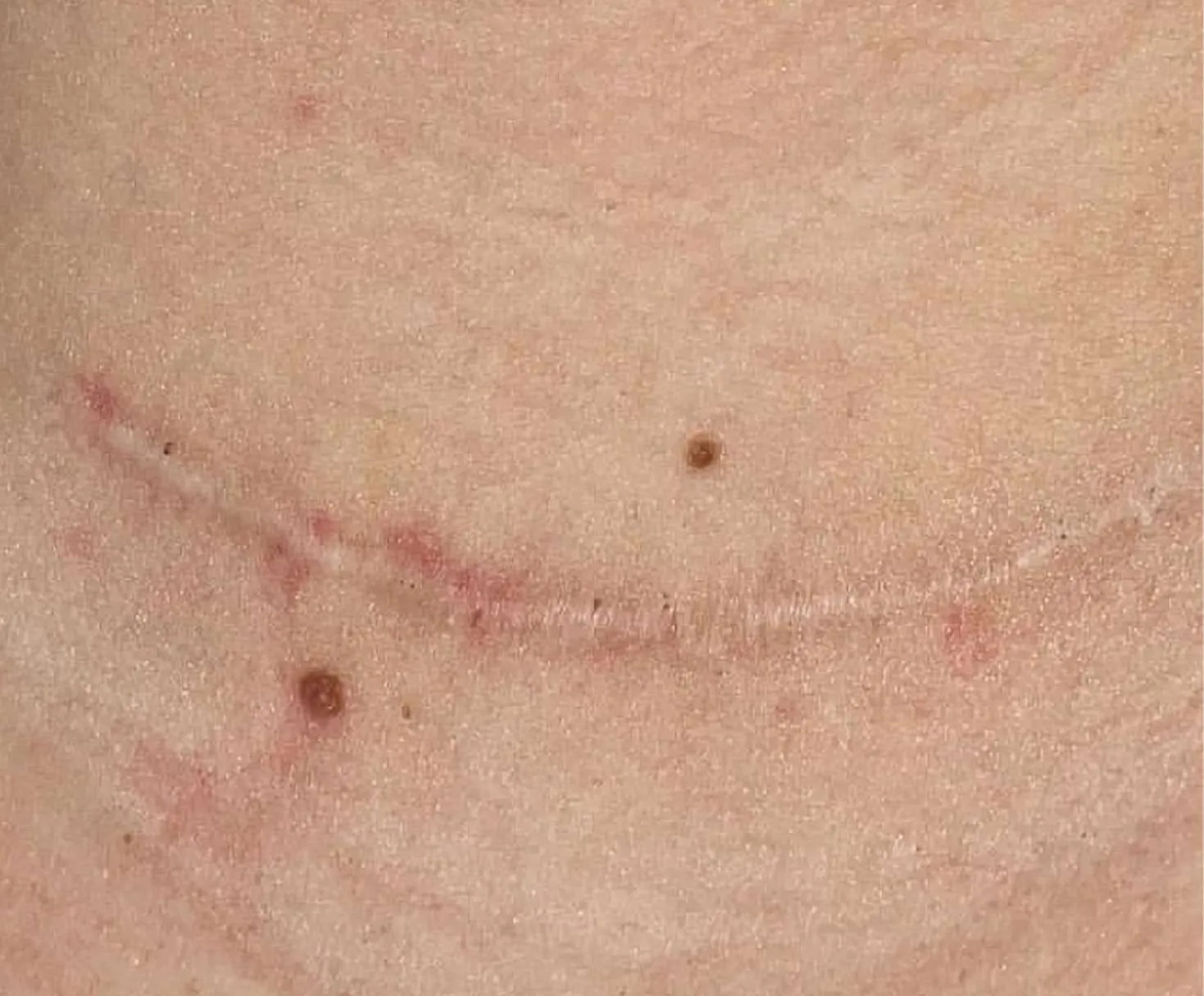 advalight results before and after