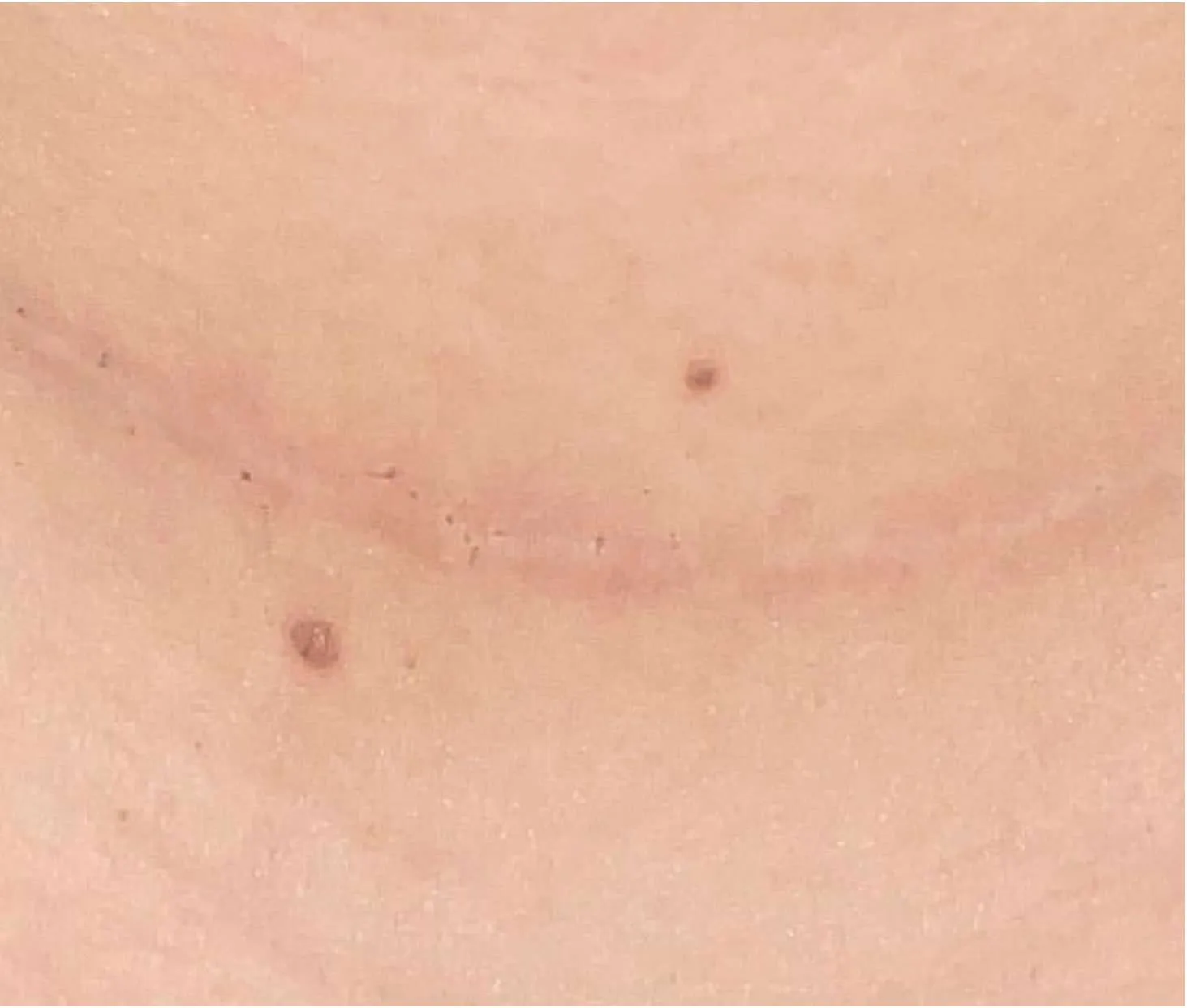 advalight results before and after