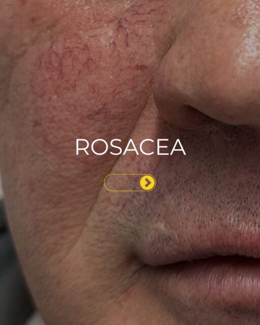 Redness doesn’t have to be permanent.

Rosacea is more than occasional flushing, it can be a persistent skin condition that affects confidence and quality of life. 

While skincare can help manage symptoms, visible redness and thread veins often require a more targeted approach.

These before & after results demonstrate the difference that advanced corrective laser technology can make when treating vascular concerns.

✨ Visible results. Minimal downtime. Real confidence.

📩 Get in touch to learn more.

#rosacea #vascularlaser #skinredness #advatx