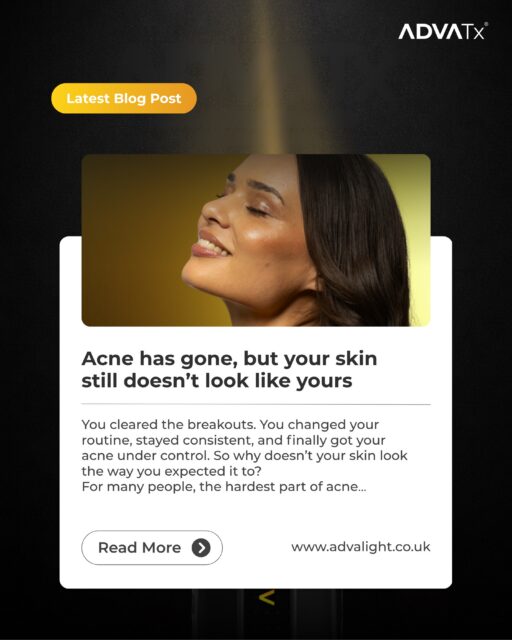 You cleared the acne. But what about what it left behind?

For many people, the hardest part of acne isn’t the breakouts themselves. It’s the pigmentation, redness and uneven texture that can remain long after the skin has cleared.

But not every post-acne mark is the same. From post-inflammatory pigmentation and redness to ice pick, boxcar and rolling scars, understanding what you’re actually treating is the first step towards creating the right approach.

In our latest blog, we explore:

✨ The difference between active acne and acne scarring
✨ Why some at-home products can’t address deeper scarring
✨ The different types of marks acne can leave behind
✨ How professional assessment can help determine the right treatment approach
✨ Where advanced light-based treatments may fit into a personalised plan

Your skin after acne can still improve.

Read the full blog via the link in our bio 🔗

#acne #lasertreatment #advatx #acnetreatment #acnescarring