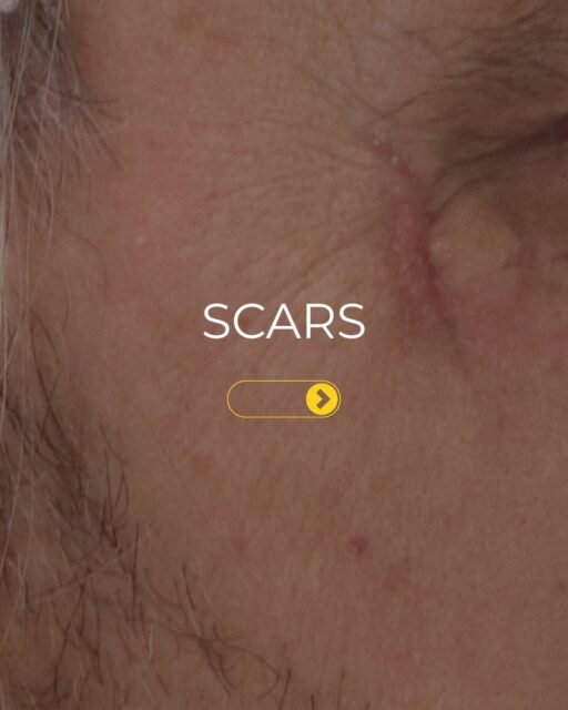 Visible improvement in vascular concerns.

This before & after shows the potential of targeted laser treatment for reducing the appearance of visible vascular concerns and improving overall skin clarity.

ADVATx combines advanced dual wavelength technology to give practitioners greater versatility when treating vascular and corrective skin concerns.

Every patient and treatment journey is different, which is why a professional consultation is essential to determine the most appropriate approach.

📩 Get in touch to learn more about ADVATx and treatment options.

#advatx #scarring #scartreatment #acnescarring #advalight