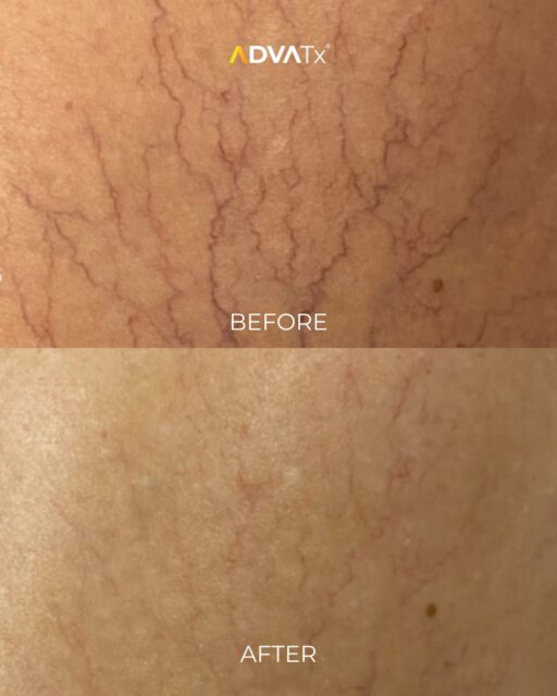 Targeting visible vessels with precision. 

Telangiectasia, commonly known as thread veins or broken capillaries, can appear as fine, visible blood vessels close to the skin's surface.

ADVATx uses advanced laser technology to target vascular concerns, helping practitioners address visible vessels as part of an individualised treatment plan.

Every patient is different, and outcomes vary depending on the individual and the concern being treated.

Interested in learning more about ADVATx's vascular treatment capabilities? Get in touch with our team.