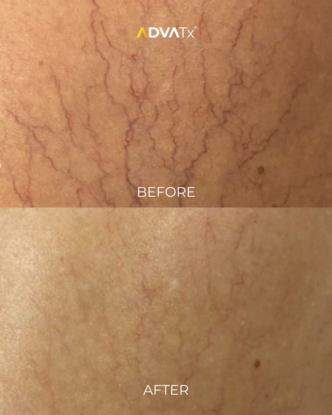 Targeting visible vessels with precision. 

Telangiectasia, commonly known as thread veins or broken capillaries, can appear as fine, visible blood vessels close to the skin's surface.

ADVATx uses advanced laser technology to target vascular concerns, helping practitioners address visible vessels as part of an individualised treatment plan.

Every patient is different, and outcomes vary depending on the individual and the concern being treated.

Interested in learning more about ADVATx's vascular treatment capabilities? Get in touch with our team.